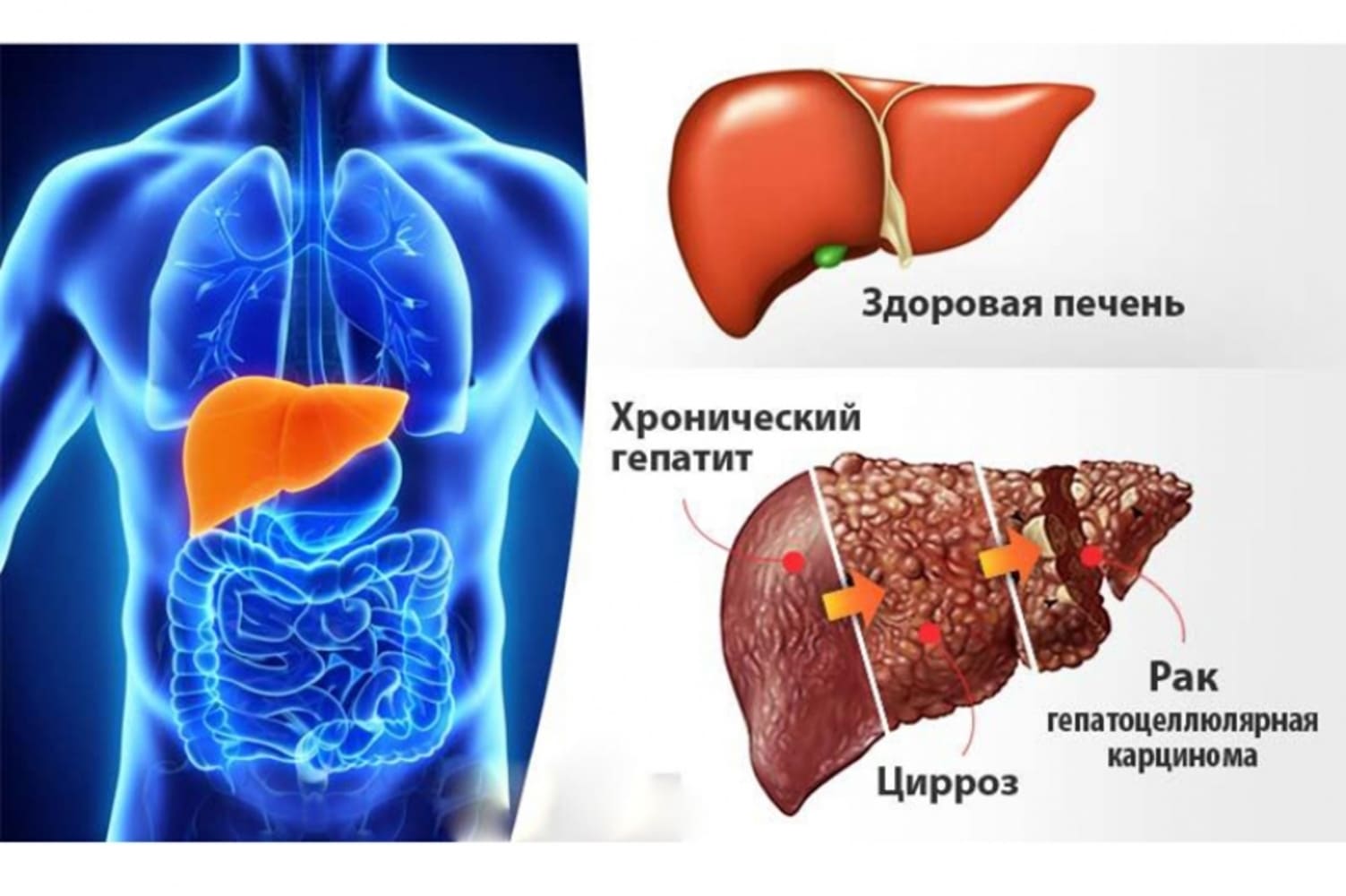 Хронический гепатит и цирроз печени